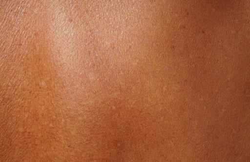 How to treat dark spots naturally at-home