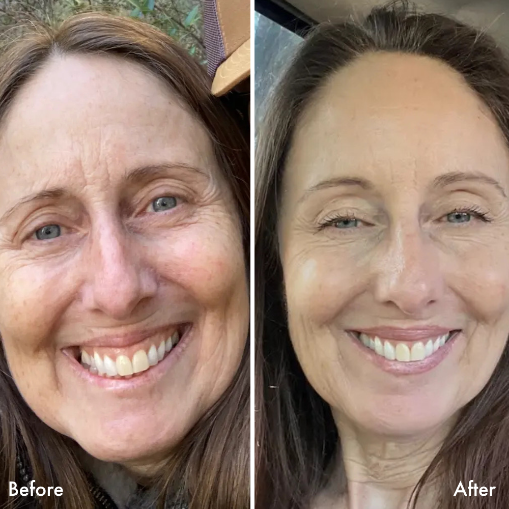Woman before and after using the NIRA Pro+ Laser to reduce wrinkles on the full face