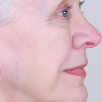 Close-up of a woman's profile and her youthful skin after using NIRA's at-home laser