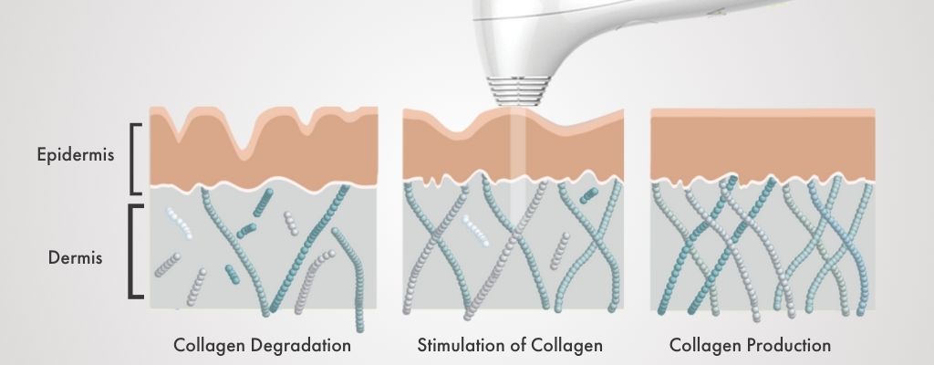 Illustration of a laser in NIRA’s Ultimate Anti-Aging Collection stimulating collagen production