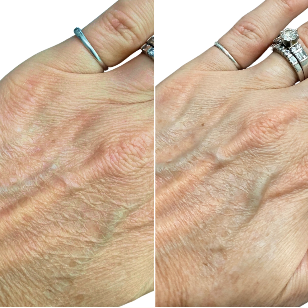 Close up of a woman's hands before and after usage of NIRA PRO on wrinkles