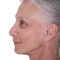 Profile shot of a woman's facial skin prior to using NIRA's anti-aging laser