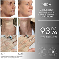 Face, neck, and hand results of using the NIRA Pro Laser included in the Ultimate Anti-Aging Collection