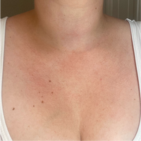 Woman's Chest After Dark Spots Lifting