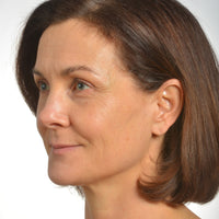 Profile shot of a woman with radiant skin achieved from using NIRA's anti-aging laser