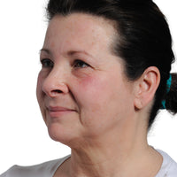 Close-up of a woman's uneven skin tone prior to treating it with NIRA's at-home laser