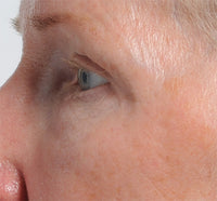 After shot of the skin tightening achieved from using NIRA's at-home laser