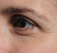 Woman before using NIRA's skincare laser to reduce under eye wrinkles