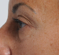 Close-up of a woman's profile showing off her tightened skin and reduced wrinkles