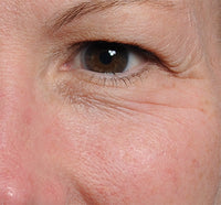 Woman before using the NIRA Precision Laser to reduce wrinkles around the eyes