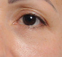 Woman with Reduced Wrinkles Under Eye After Using the NIRA Precision Laser