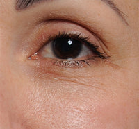 Woman before using NIRA's skincare laser to reduce eye wrinkles
