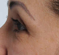 Woman before using NIRA's anti-aging laser to treat under eye wrinkles