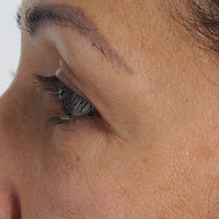 Woman Before and After using NIRA for Hooded Eyes Treatment