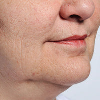 Woman before using the NIRA Precision Laser to treat mouth lines