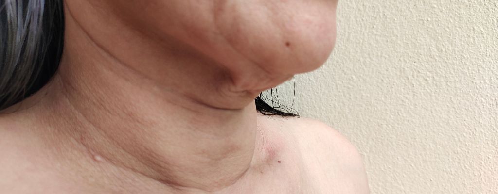 Woman with sagging and loose skin under her chin