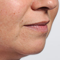 Woman before using NIRA's at-home wrinkle laser to reduce mouth lines