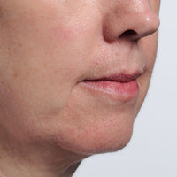 Woman before using NIRA's at-home skincare laser to treat mouth lines