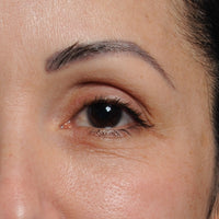 Woman before using NIRA's anti-aging laser to reduce eye wrinkles