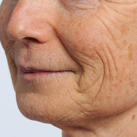 Woman before using NIRA's anti-aging laser to treat mouth wrinkles