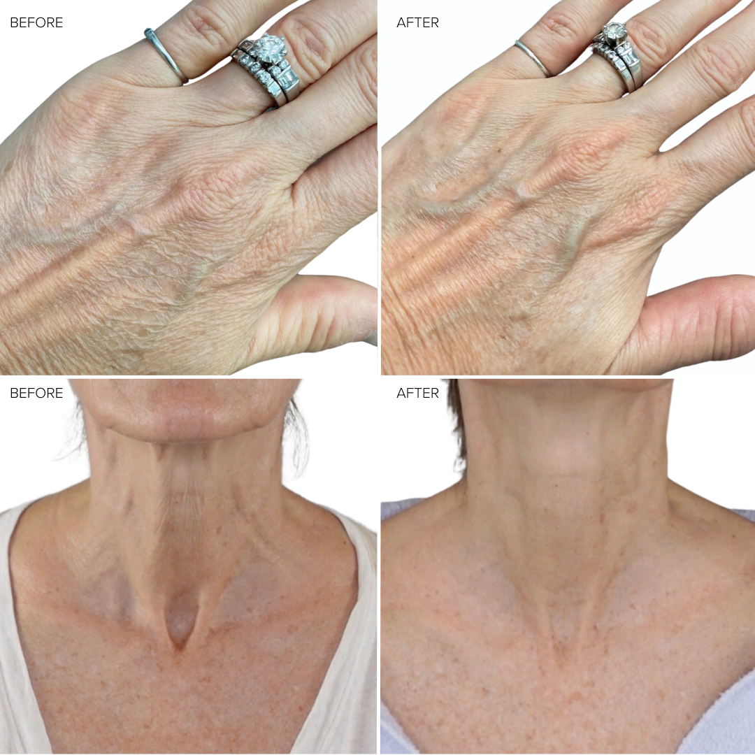 NIRA Laser Bundle+ | Pro+ & Precision Lasers for Anti-Aging Care