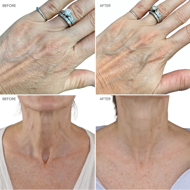 The Science Behind Laser Treatments for Wrinkles and Fine Lines 4 NIRA laser close-up