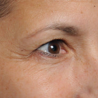 Woman before using NIRA's anti-aging laser to reduce dark circles and brighten eyes