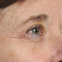 Woman before using NIRA's rejuvenating laser to reduce dark circles around the eyes
