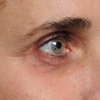 Woman before using NIRA's anti-aging laser to treat dark circles around the eyes