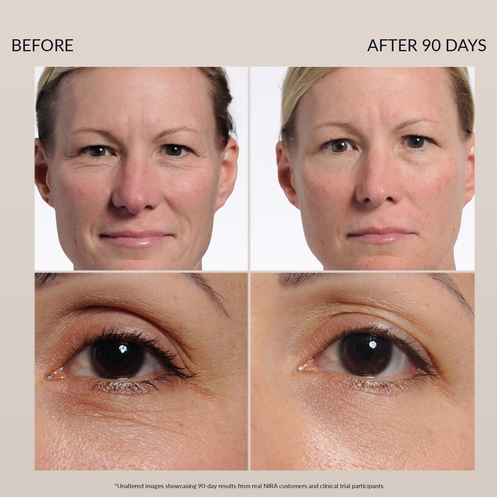 Before and after comparison of facial skin showing effects after 90 days using nira pro 3 laser treatment