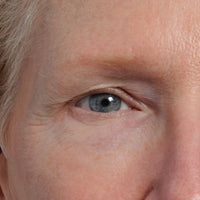 Woman before using NIRA's anti-aging laser to lift hooded eyes
