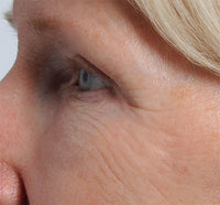 Woman before using NIRA's at-home laser to treat under eye wrinkles