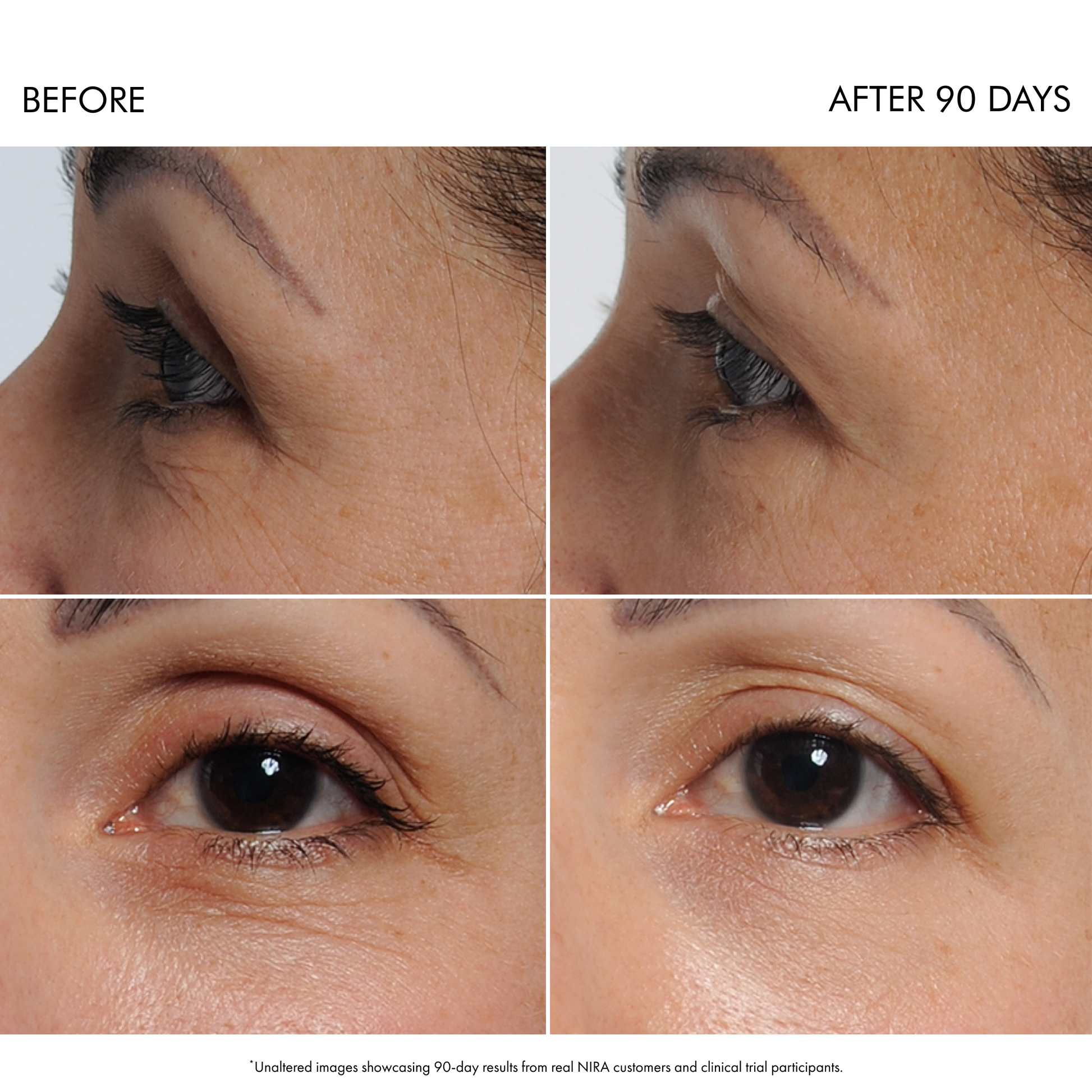 recommend a non-invasive machine for eyelid wrinkles after semaglutide. NIRA Precision Laser