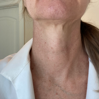 Woman showing her neck's skin texture before trying NIRA's anti-aging laser