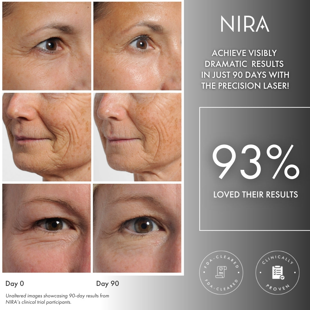Wrinkle reduction around the eyes and mouth as a result of using the NIRA Ultimate Laser Bundle