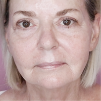 Woman with Improved Marionette Lines and Forehead Wrinkles From using the NIRA Pro Laser