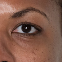 Woman before using NIRA's anti-aging laser to brighten eyes