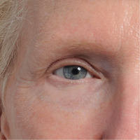 Close-up of a woman's skin renewal after using the NIRA Precision at-home laser