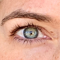 Woman before using NIRA's wrinkle-reducing laser to lift hooded eyes