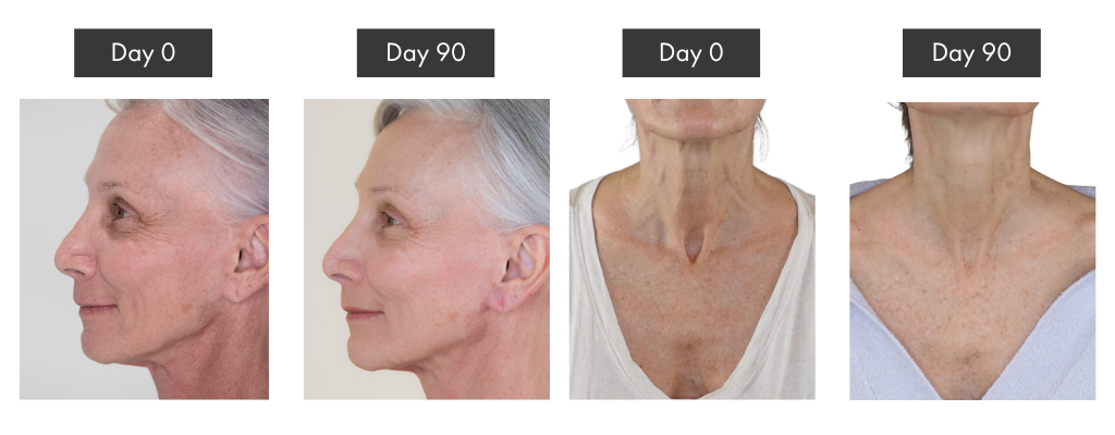 90 day wrinkle reduction results of face, neck, and chest after using the NIRA Pro Laser