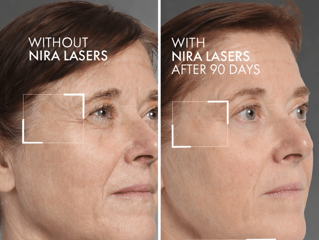 Before and after facial skin treatment with nira pro 3 laser showing wrinkle reduction and improved texture after 90 days