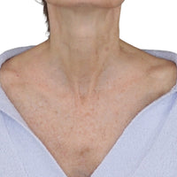 After shot of woman who saw tighter skin on her neck thanks to NIRA's anti-aging laser