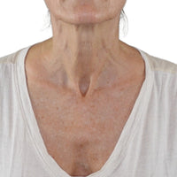 Woman with wrinkled neck skin before using the NIRA Pro Anti Aging Laser