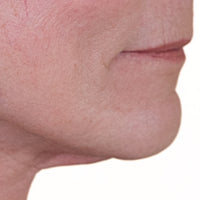 Woman shows the skin-firming results around mouth from using NIRA's anti-aging laser