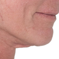 Woman before using NIRA's anti-aging laser to tighten skin on her chin