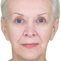 Older Woman Before & After NIRA Laser