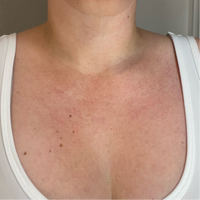 Woman shows her discolored skin on her chest before she starts using NIRA's at-home laser