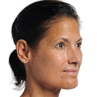 Woman with reduced wrinkles after using NIRA's anti-aging laser