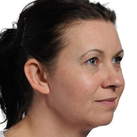 Woman with uneven skin texture before she uses the NIRA's at-home laser