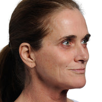 Woman Before Improving Skin Tone with NIRA Lasers